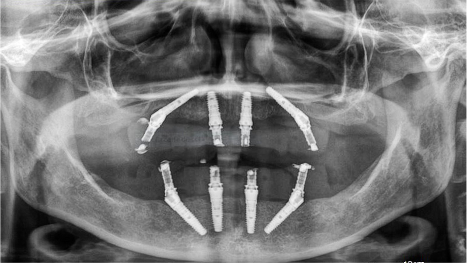 All-on-4, free-hand, full-arch case operated by Dr. Bernardo Sousa