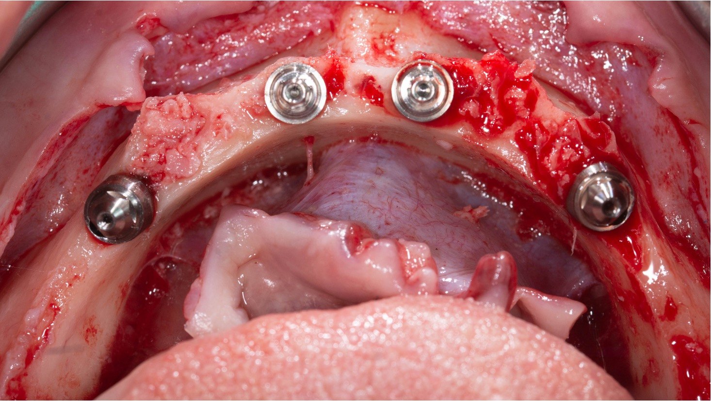 All-on-4 in the mandible, full-arch case operated by Dr. Bernardo Sousa
