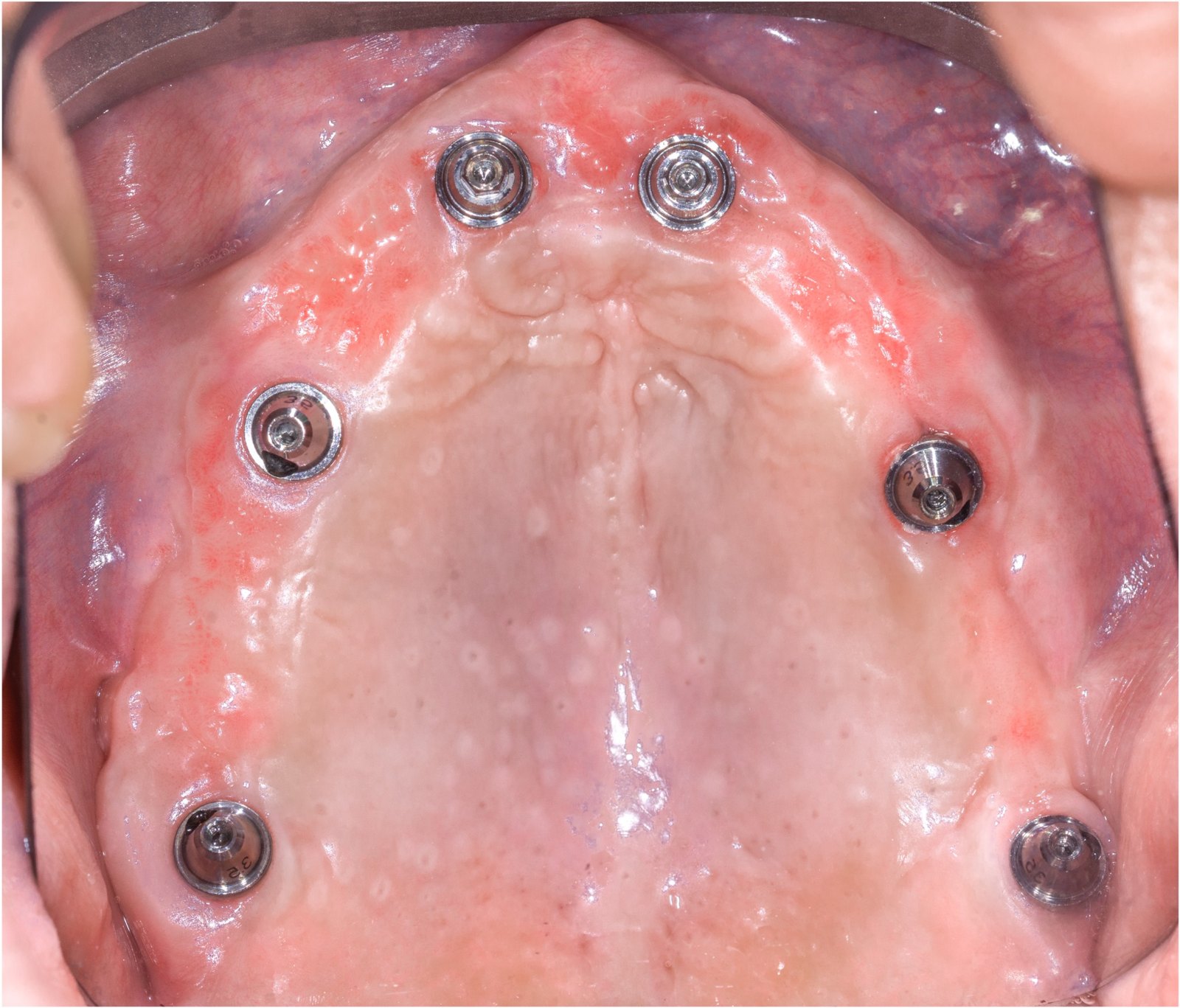 All-on-X with pterygoids, full-arch case operated by Dr. Bernardo Sousa