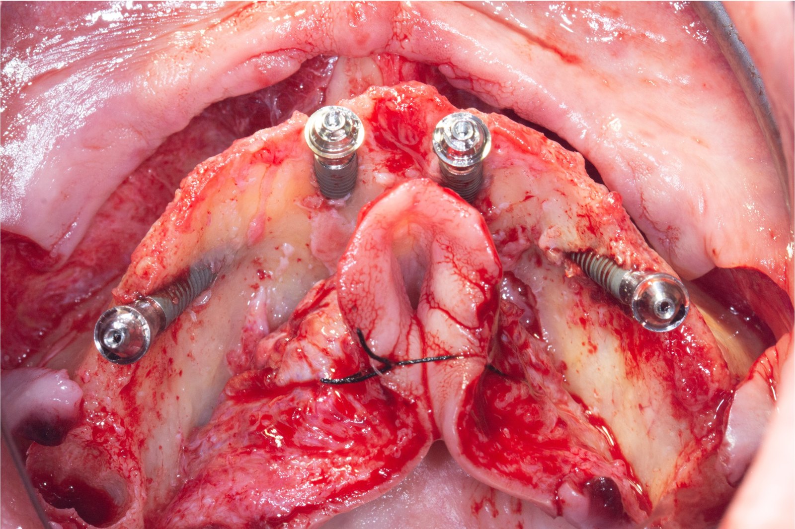 The Palatal Approach, full-arch case operated by Dr. Bernardo Sousa