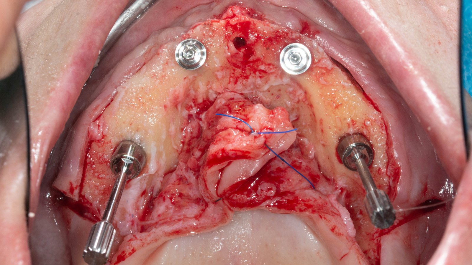 Standard All-on-4, full-arch case operated by Dr. Bernardo Sousa