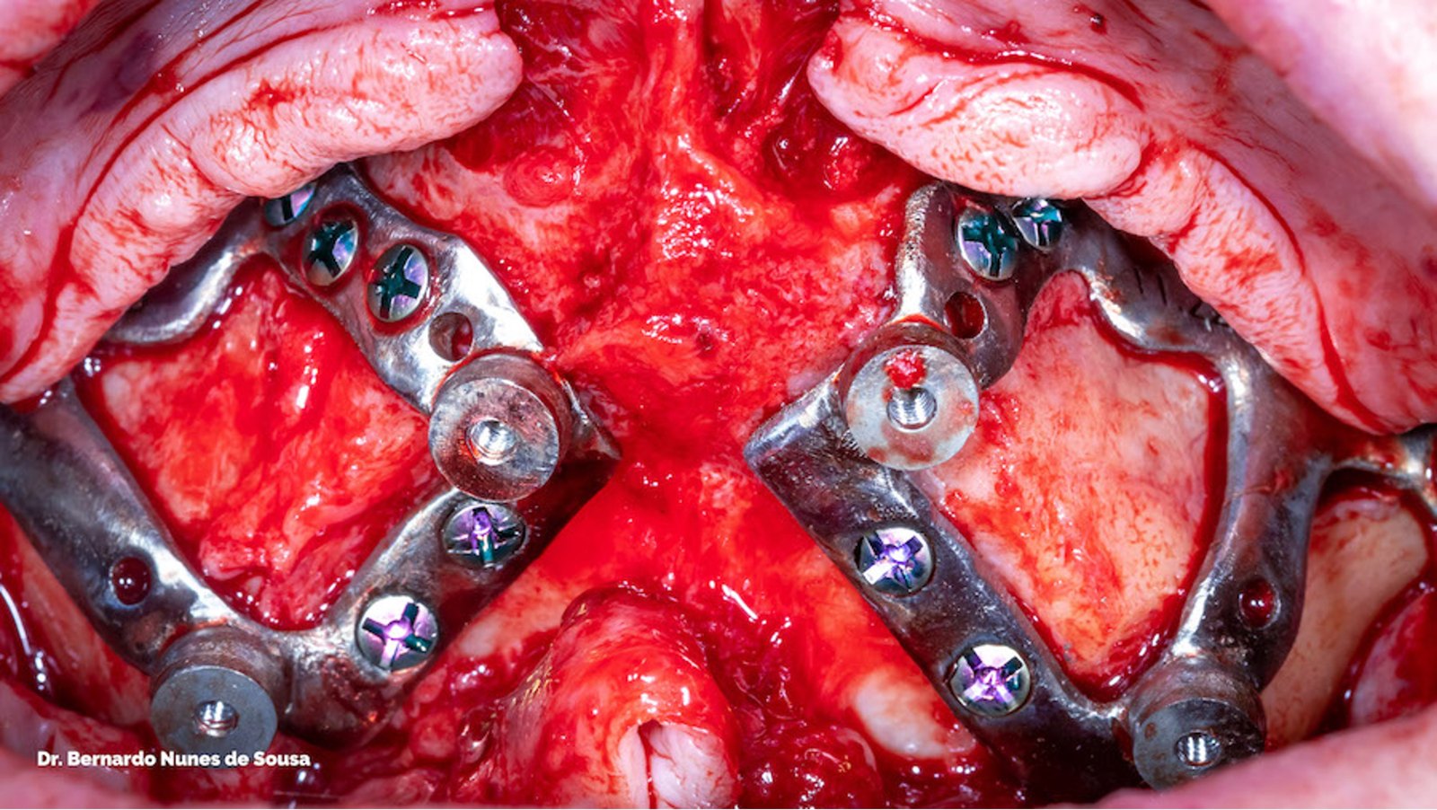 Custom subperiosteal in the maxilla, full-arch case operated by Dr. Bernardo Sousa