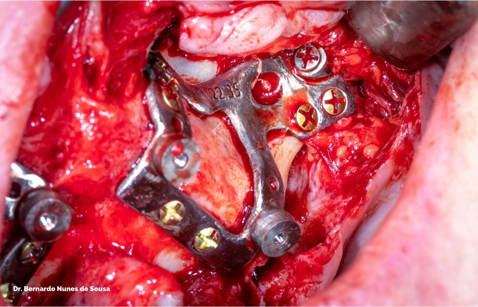 Zygo anchorage on subperiosteal, full-arch case operated by Dr. Bernardo Sousa