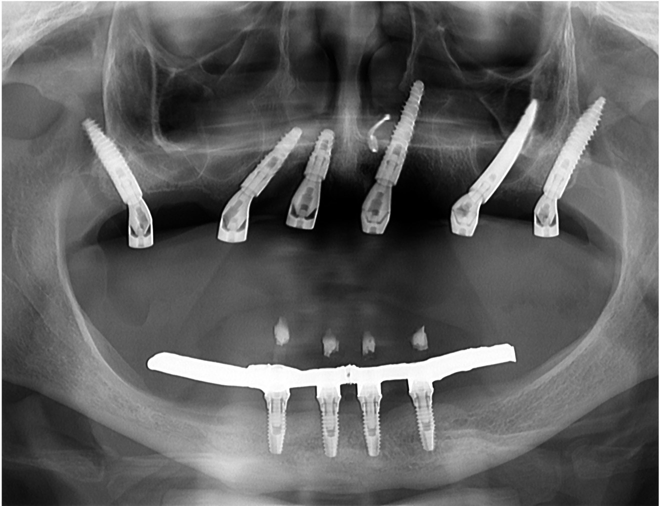 Zygoma, trans-nasal, pterygoids, bicortical anchorage, full-arch case operated by Dr. Bernardo Sousa